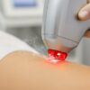 Laser Hair Removal