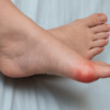 Bunion Surgery as a Structural Correction, Not a Cosmetic Fix