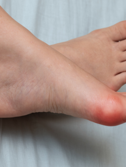 Bunion Surgery as a Structural Correction, Not a Cosmetic Fix