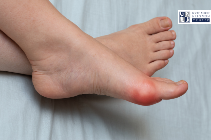 Bunion Surgery as a Structural Correction, Not a Cosmetic Fix